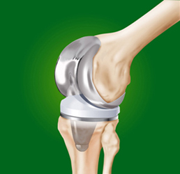 Pròtesis de genoll